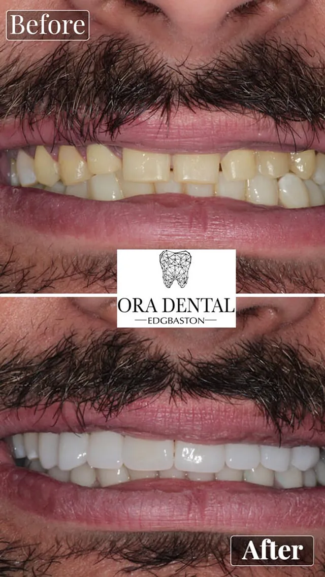 Before & After Ora Dental